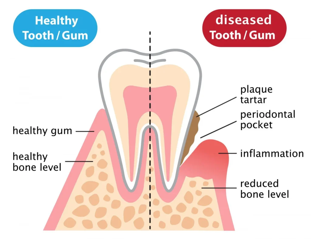 Healthy gums compared with periodontal disease and bone loss in Creve Coeur MO